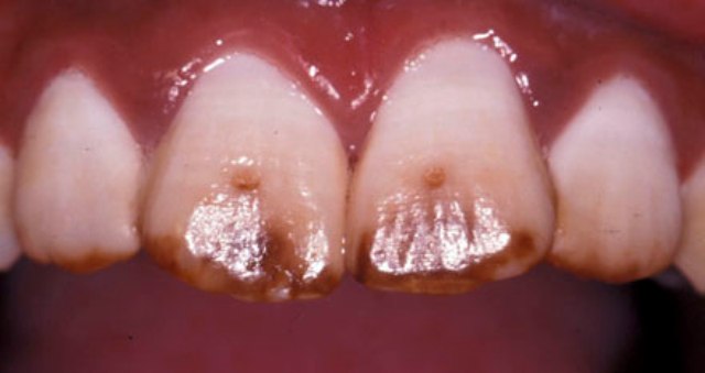 otbelivanie-zubov-v-klinike