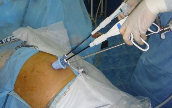 laparoskopicheskoe-bandazhirovanie-zheludka