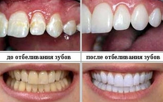 otbelivanie-zubov-v-klinike